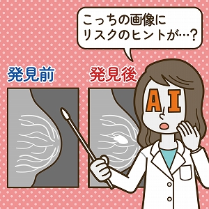 異常のない検査画像から乳がんのリスクを予測！　AI画像診断支援